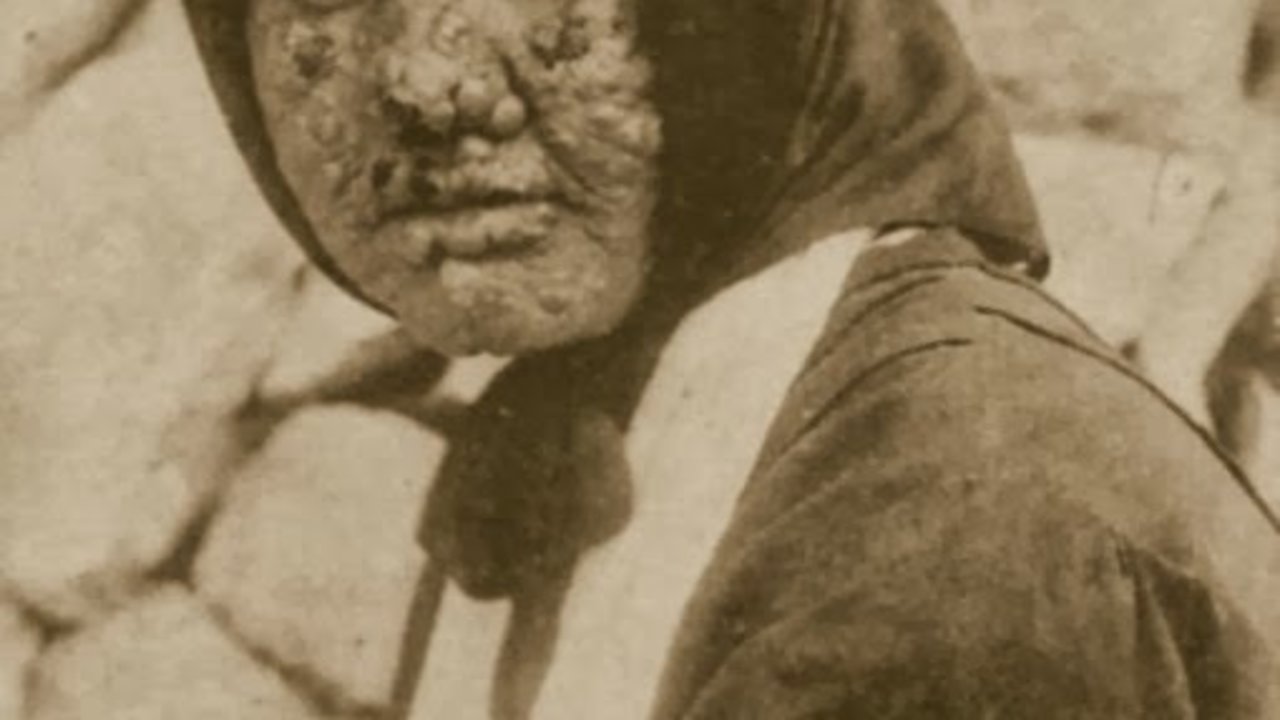 Una enferma de lepra atendida en el sanatorio Fontilles a principios de 1900. 